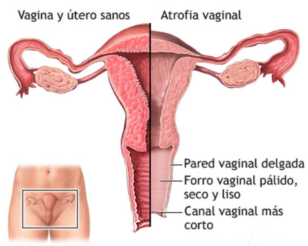 sequedad-vaginal-atrofia