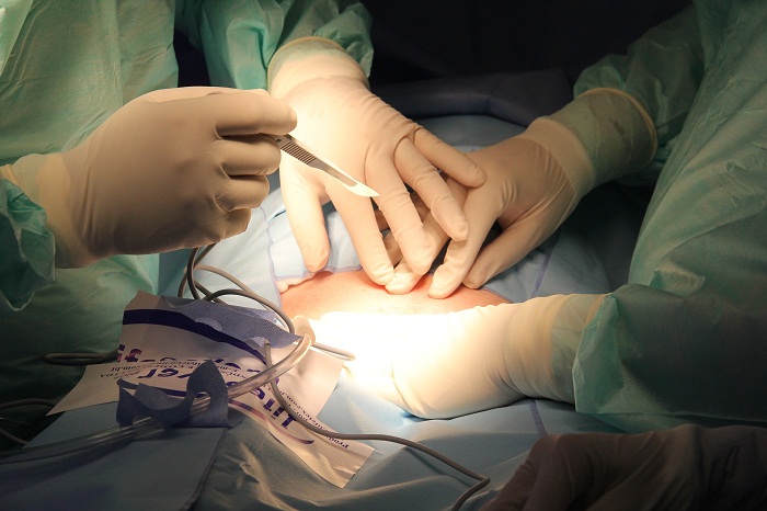 Himenoplastia