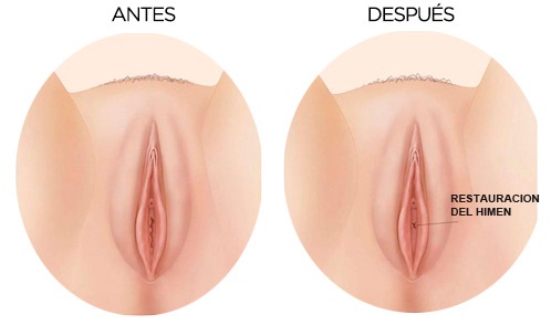 Himenoplastia