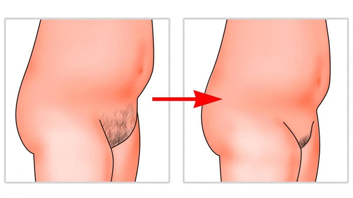 Lipomodelacion del monte de venus