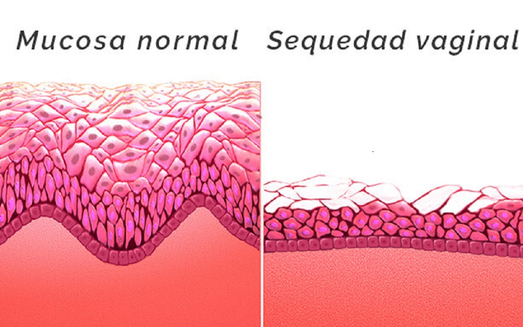 vaginitis atrófica