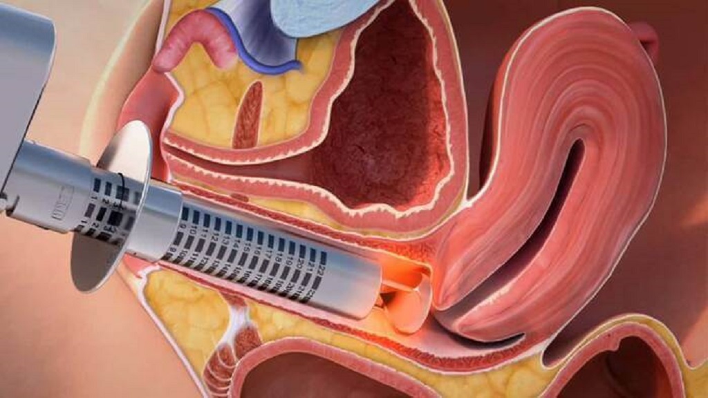 Sequedad vaginal tratada con laser diodo