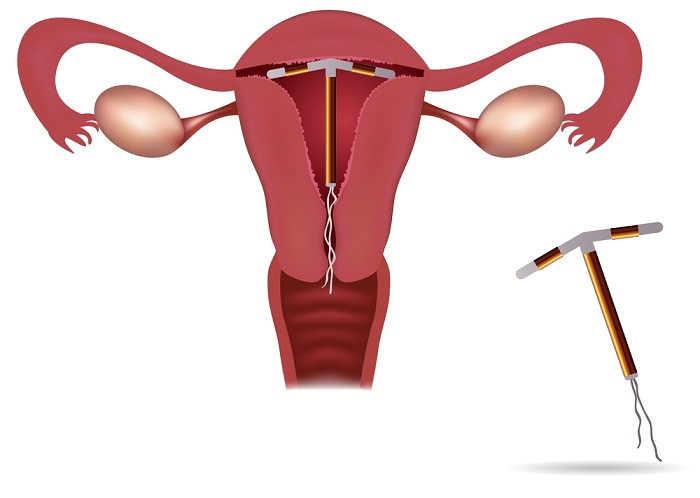 inserción del DIU en el útero