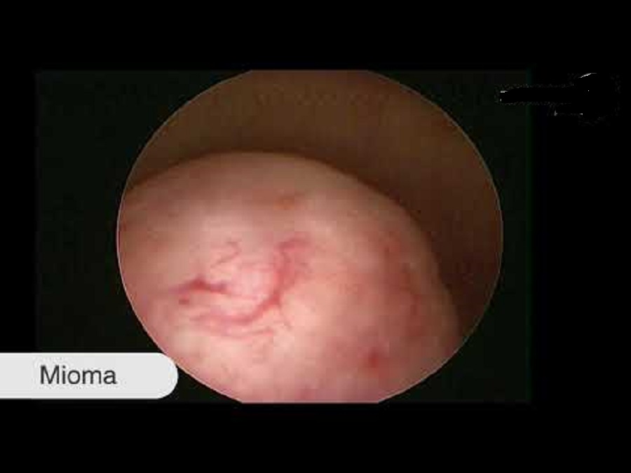 Histeroscopia diagnóstica