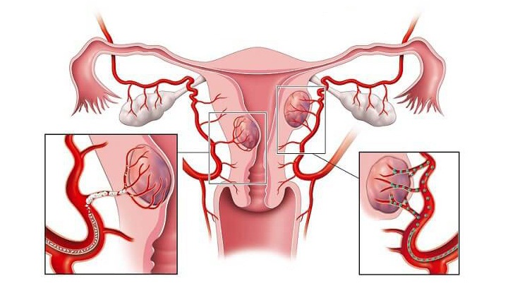 Miomas presentes en el útero