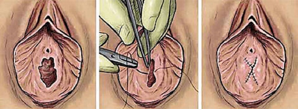 Himenoplastia