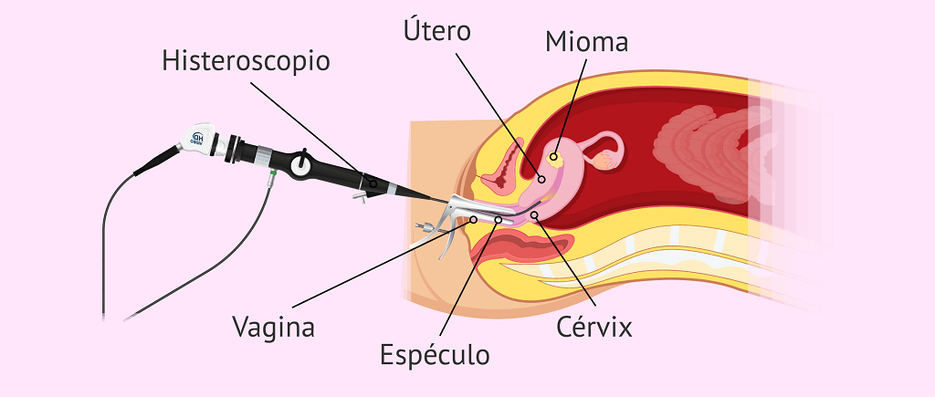 Histeroscopia diagnóstica y quirúrgica