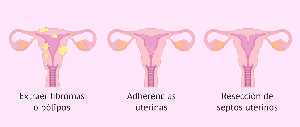Histeroscopia diagnóstica