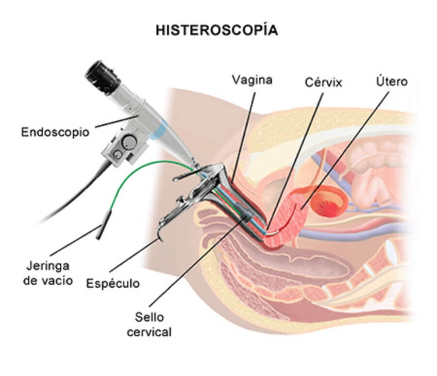 Histeroscopia diagnóstica