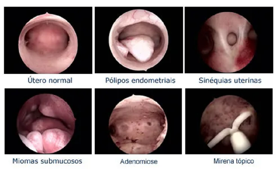 Histeroscopia diagnóstica