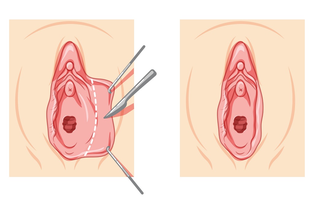 Labioplastia de labios menores