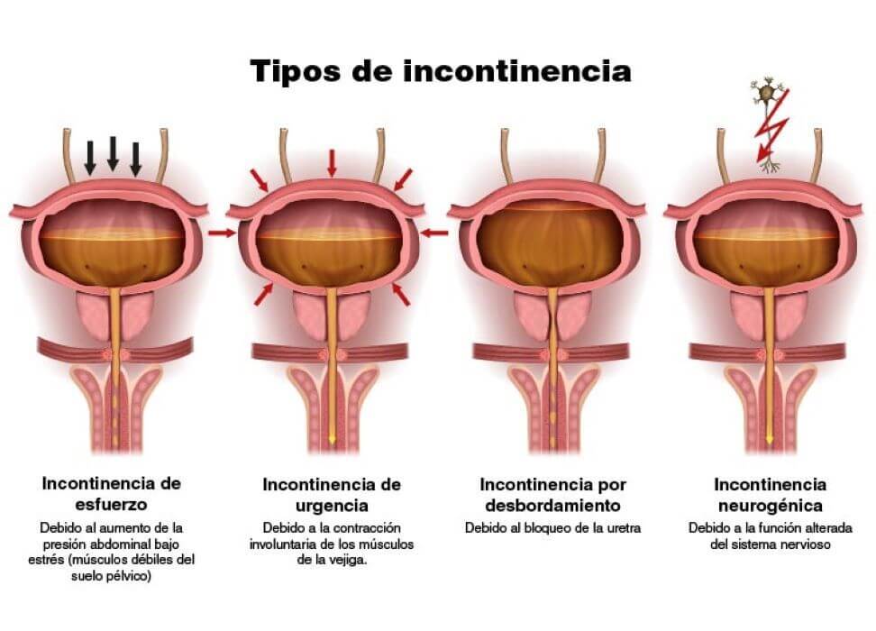 incontinencia urinaria